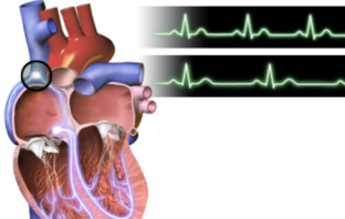 rice-size galvanic pacemaker