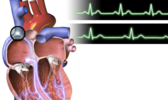 rice-size galvanic pacemaker