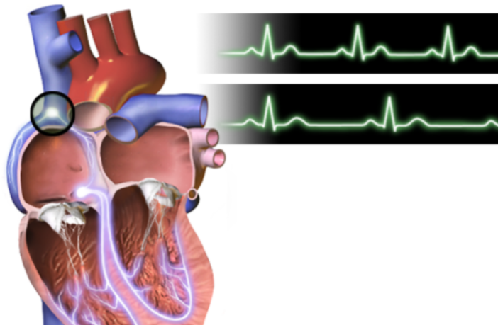 rice-size galvanic pacemaker