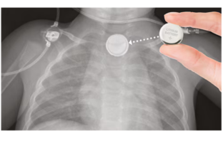 another child another button battery