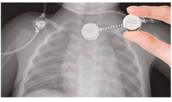 another child another button battery