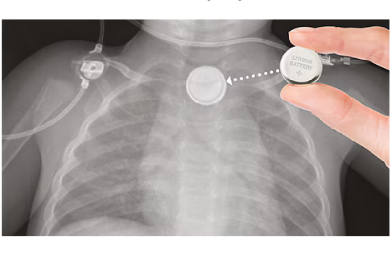 another child another button battery